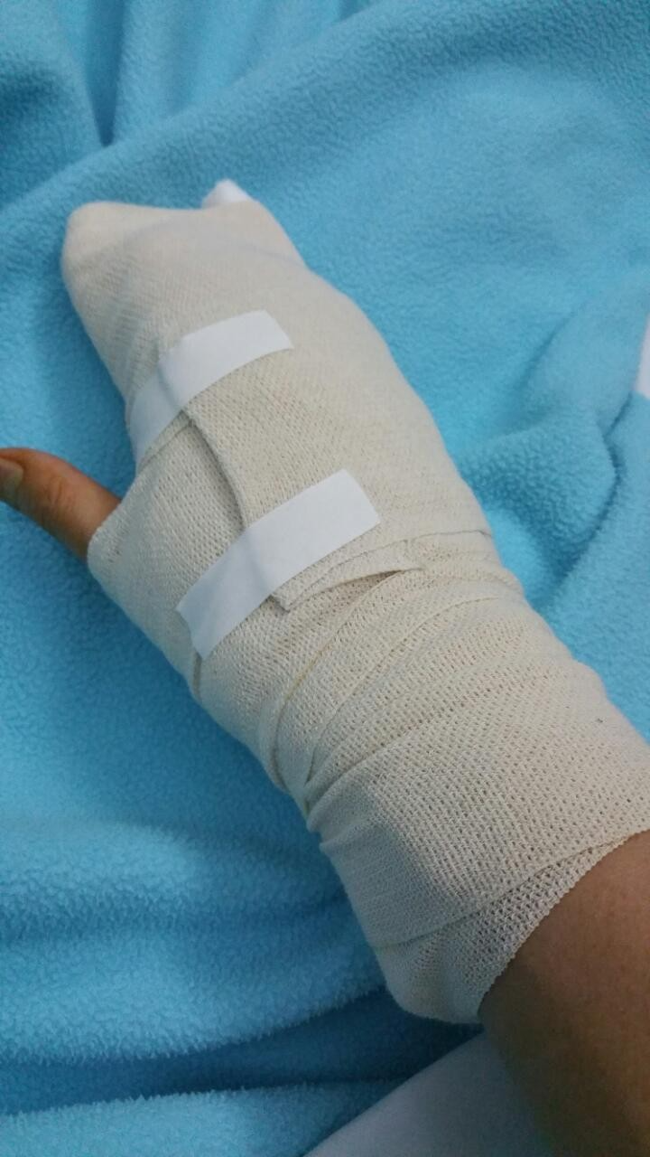 손가락 거대세포종 - 오늘생각