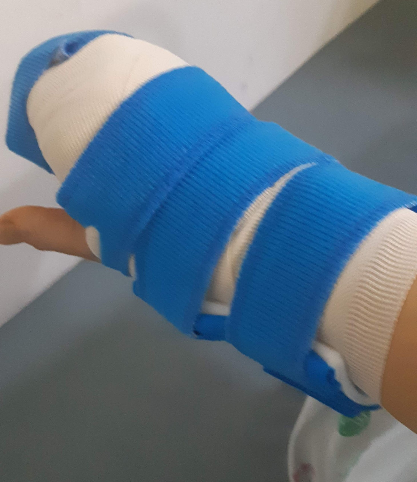 손가락 거대세포종 - 오늘생각